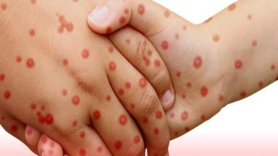 ارتفاع ملحوظ في حالات الحصبة بإقليم العرائش واستجابة صحية شاملة